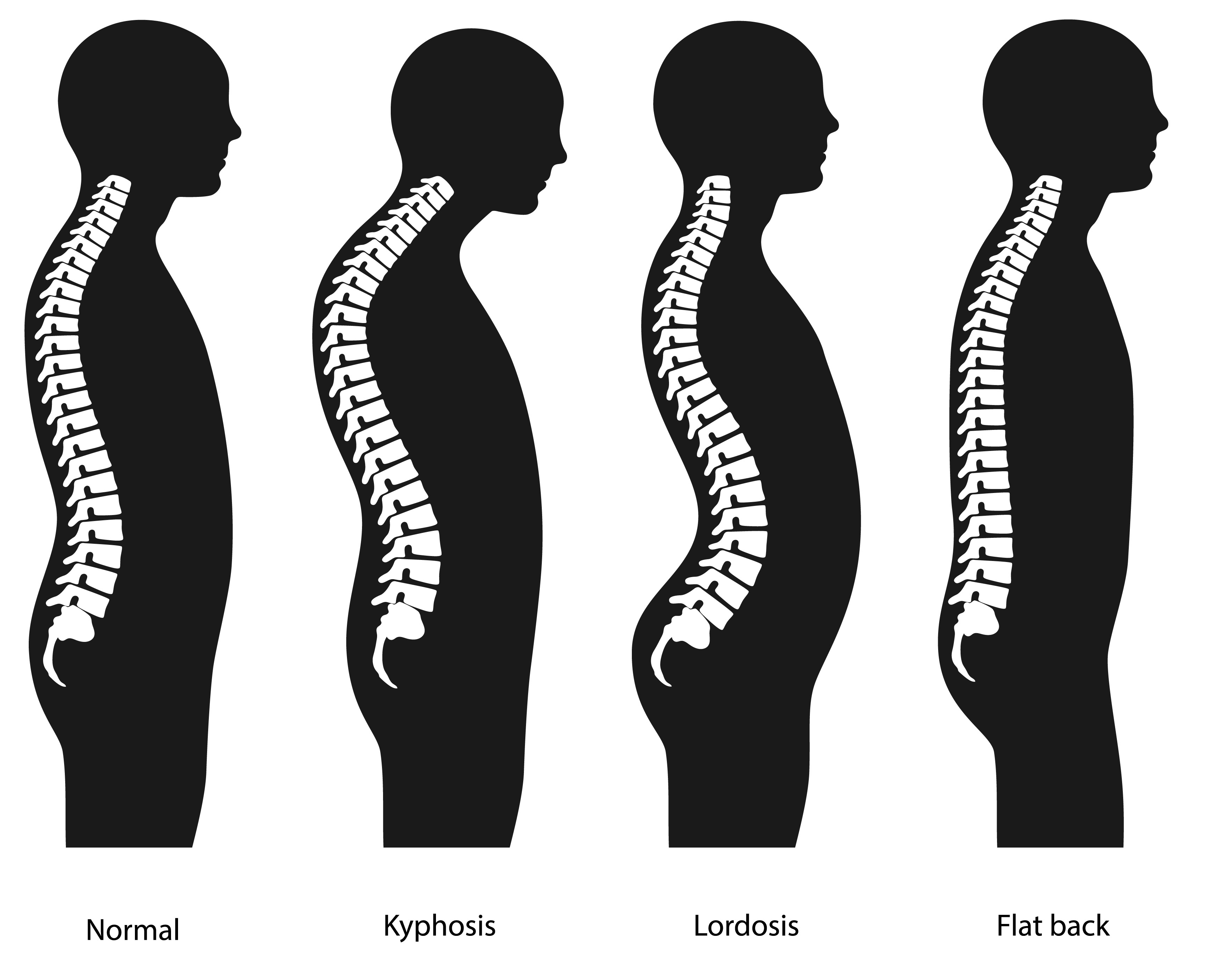 Kifoz Çeşitleri Nelerdir?